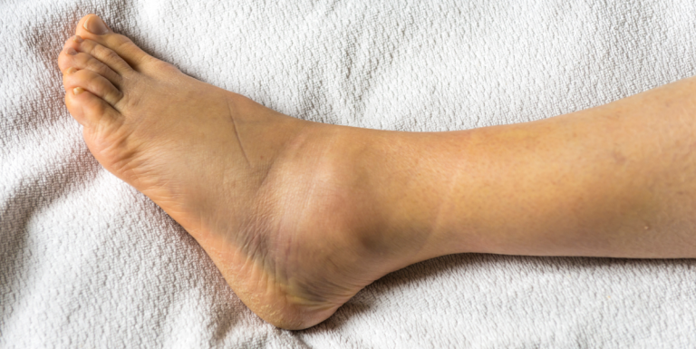 Photo showing swollen ankles with visibly enlarged and puffy skin